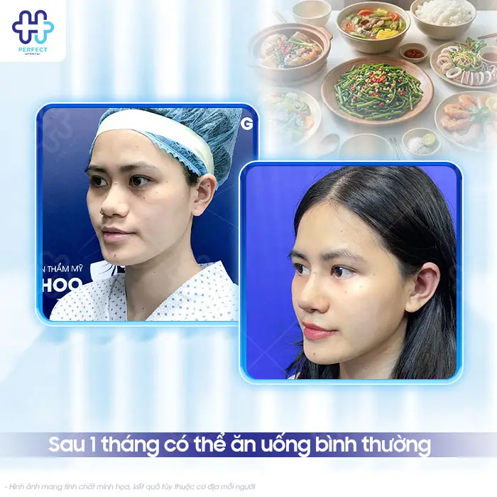 Nâng Mũi Bao Lâu Được Ăn Rau Muống? Kiêng Bao Lâu An Toàn