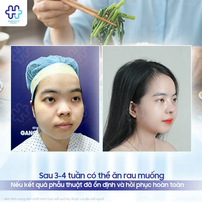 Nâng Mũi Bao Lâu Được Ăn Rau Muống? Kiêng Bao Lâu An Toàn