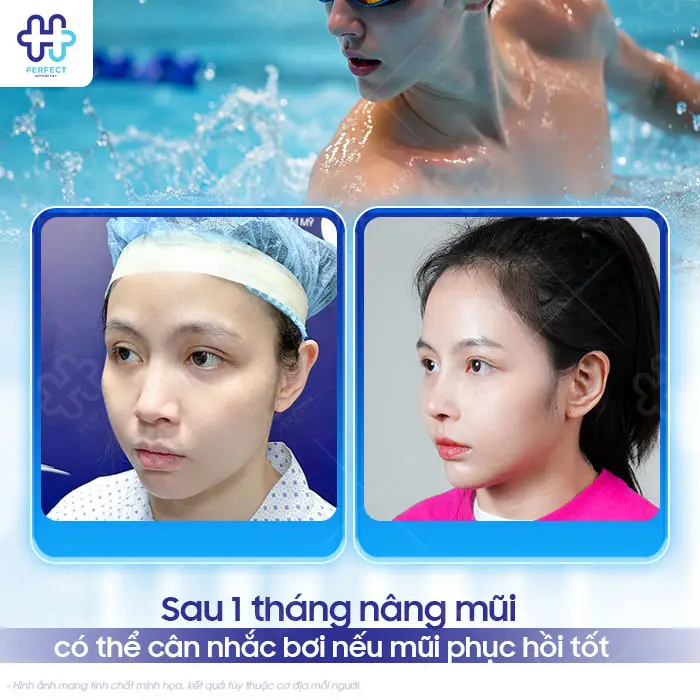 Nâng Mũi Bao Lâu Thì Đi Bơi Được? Thời Điểm An Toàn Cần Biết