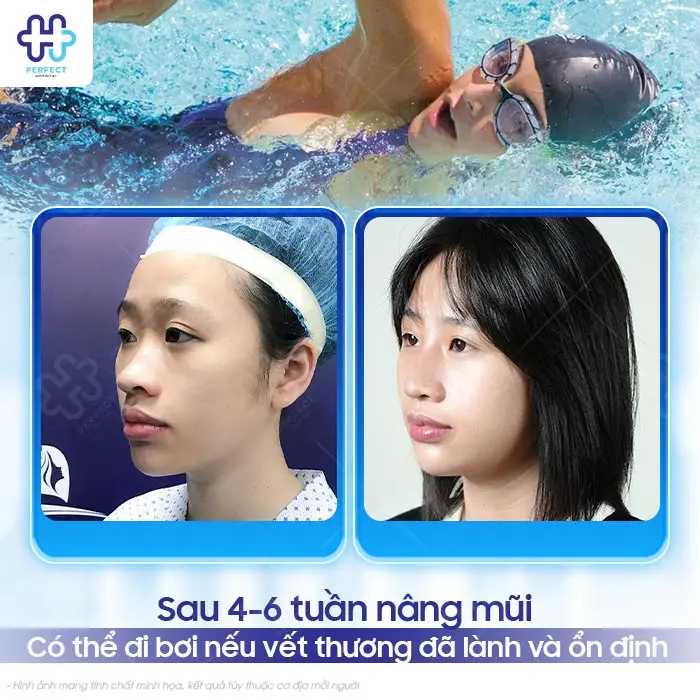 Nâng Mũi Bao Lâu Thì Đi Bơi Được? Thời Điểm An Toàn Cần Biết