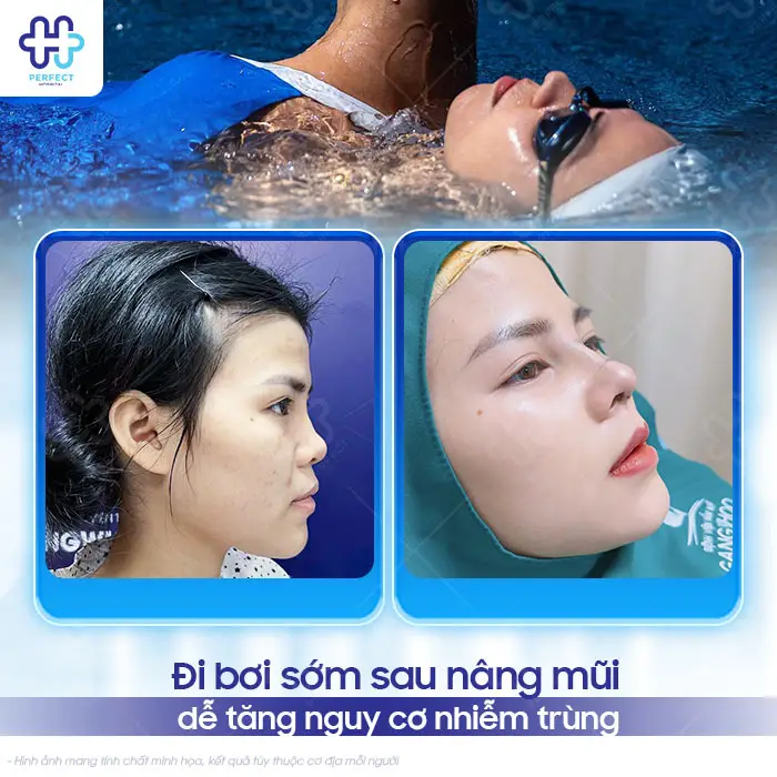 Nâng Mũi Bao Lâu Thì Đi Bơi Được? Thời Điểm An Toàn Cần Biết