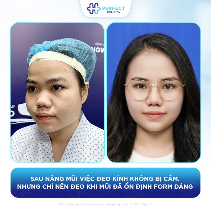 Nâng Mũi Bao Lâu Thì Được Đeo Kính An Toàn Không Ảnh Hưởng Dáng