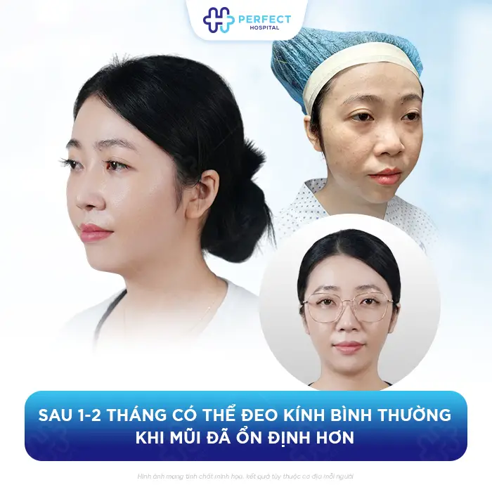 Nâng Mũi Bao Lâu Thì Được Đeo Kính An Toàn Không Ảnh Hưởng Dáng