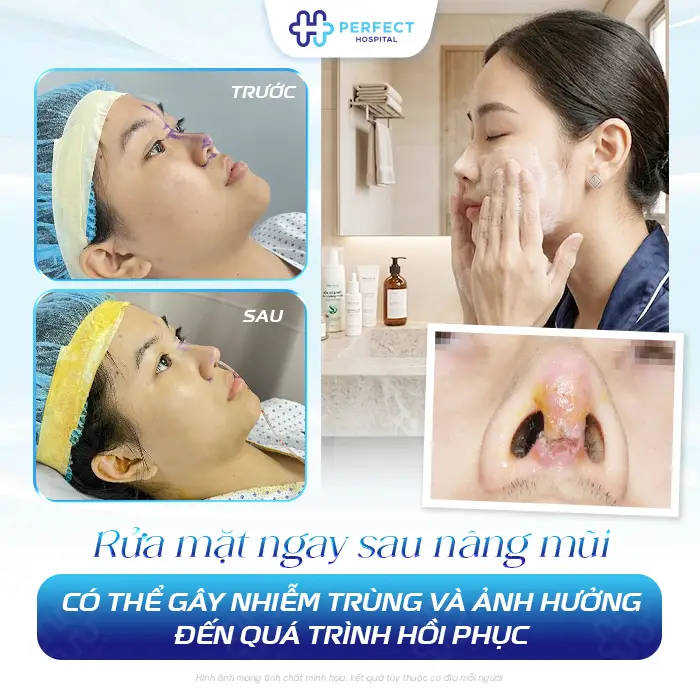 Nâng Mũi Bao Lâu Thì Được Dùng Sữa Rửa Mặt An Toàn Cho Mũi
