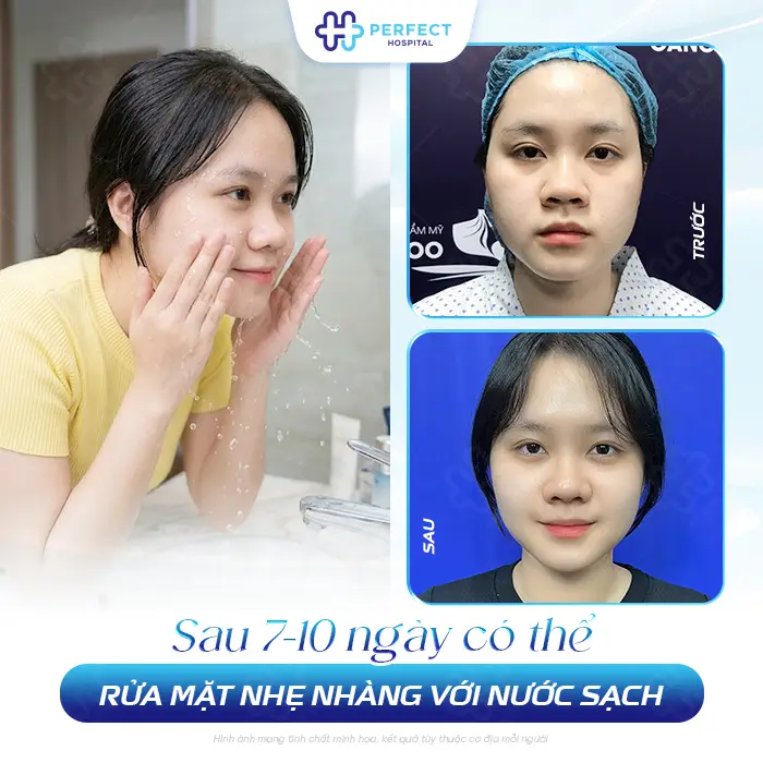 Nâng Mũi Bao Lâu Thì Được Dùng Sữa Rửa Mặt An Toàn Cho Mũi