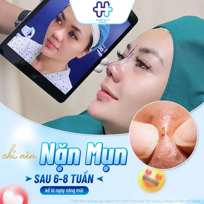 Nâng Mũi Bao Lâu Thì Được Nặn Mụn? Bác Sĩ Giải Đáp An Toàn