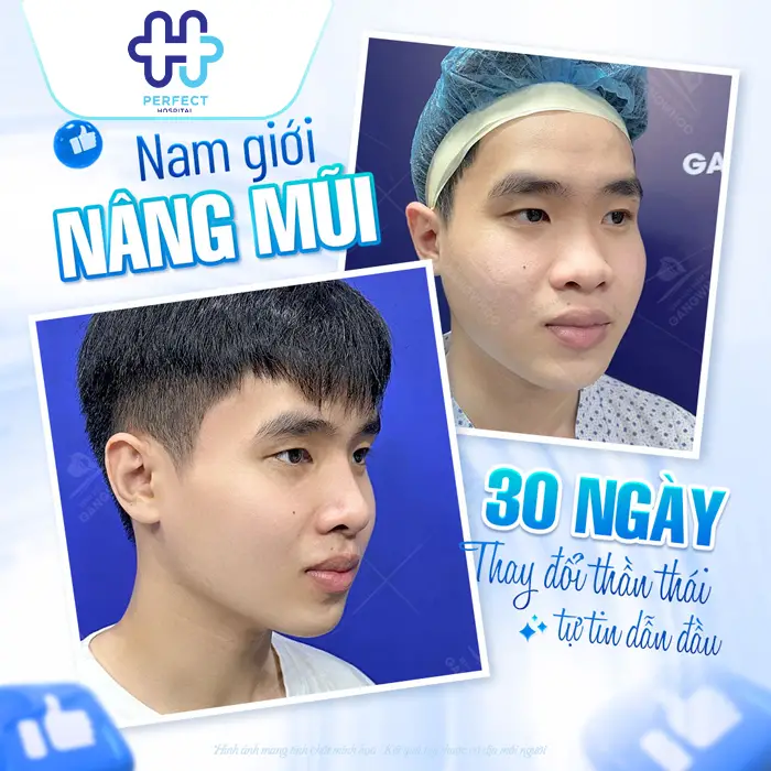 Nâng Mũi Bao Lâu Thì Lành Hẳn? Thời Gian Hồi Phục Chi Tiết