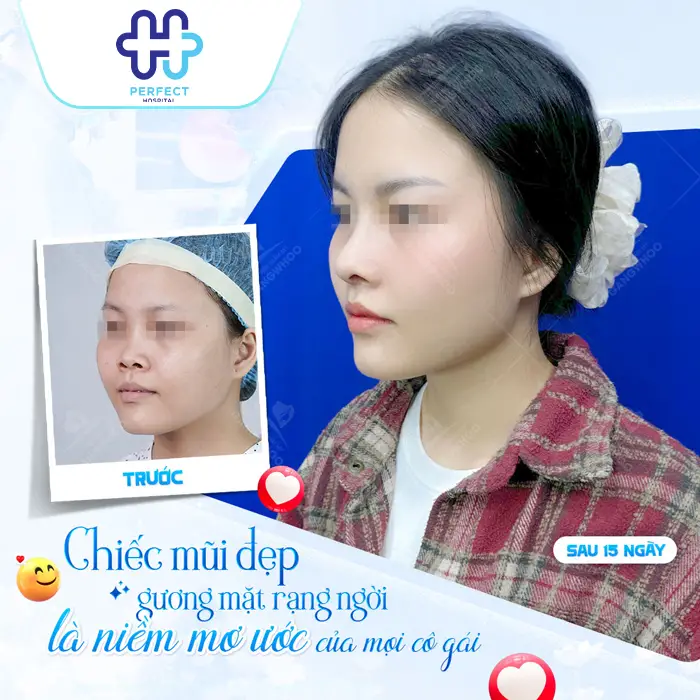 Nâng Mũi Bao Lâu Thì Lành Hẳn? Thời Gian Hồi Phục Chi Tiết