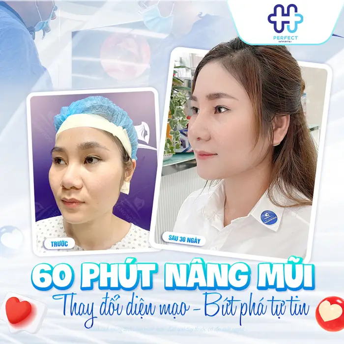 Nâng Mũi Bao Lâu Thì Lành Hẳn? Thời Gian Hồi Phục Chi Tiết