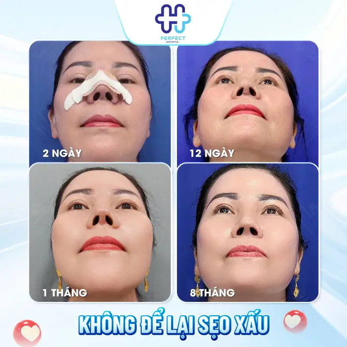 Nâng Mũi Bao Lâu Thì Lành Hẳn? Thời Gian Hồi Phục Chi Tiết