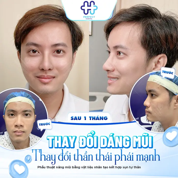 Nâng Mũi Bao Lâu Thì Lành Hẳn? Thời Gian Hồi Phục Chi Tiết