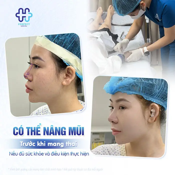 Nâng Mũi Bao Lâu Thì Mang Thai Được? Bác Sĩ Giải Đáp Chi Tiết