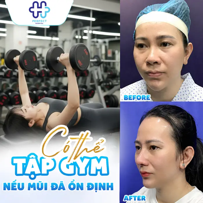 Nâng Mũi Bao Lâu Thì Tập Gym Được Và Thời Điểm An Toàn Nhất