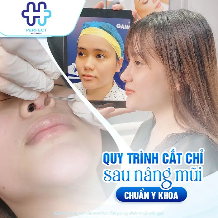 Nâng Mũi Bao Nhiêu Ngày Cắt Chỉ? Thời Gian Chuẩn Và Lưu Ý Quan Trọng