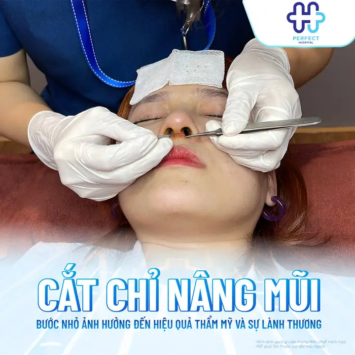 Nâng Mũi Bao Nhiêu Ngày Cắt Chỉ? Thời Gian Chuẩn Và Lưu Ý Quan Trọng