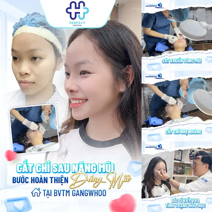 Nâng Mũi Bao Nhiêu Ngày Cắt Chỉ? Thời Gian Chuẩn Và Lưu Ý Quan Trọng