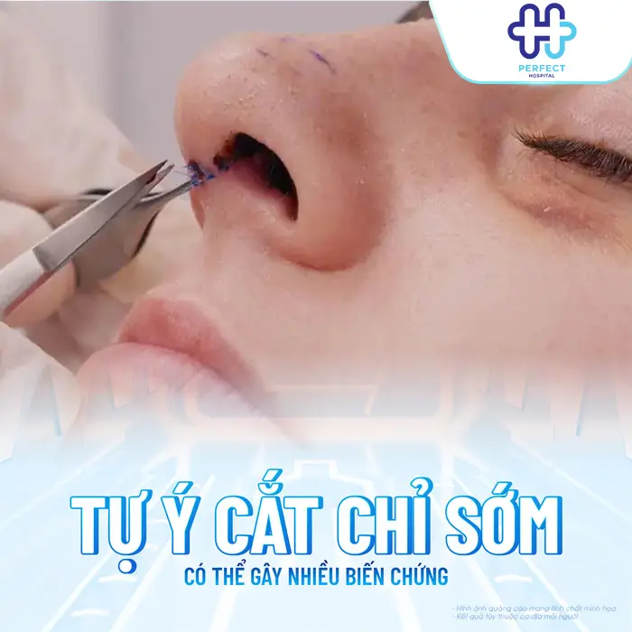 Nâng Mũi Bao Nhiêu Ngày Cắt Chỉ? Thời Gian Chuẩn Và Lưu Ý Quan Trọng