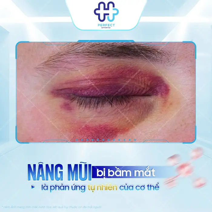 Nâng Mũi Bị Bầm Mắt Có Sao Không Và Cách Giảm Tím Nhanh