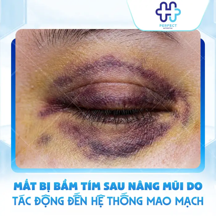 Nâng Mũi Bị Bầm Mắt Có Sao Không Và Cách Giảm Tím Nhanh