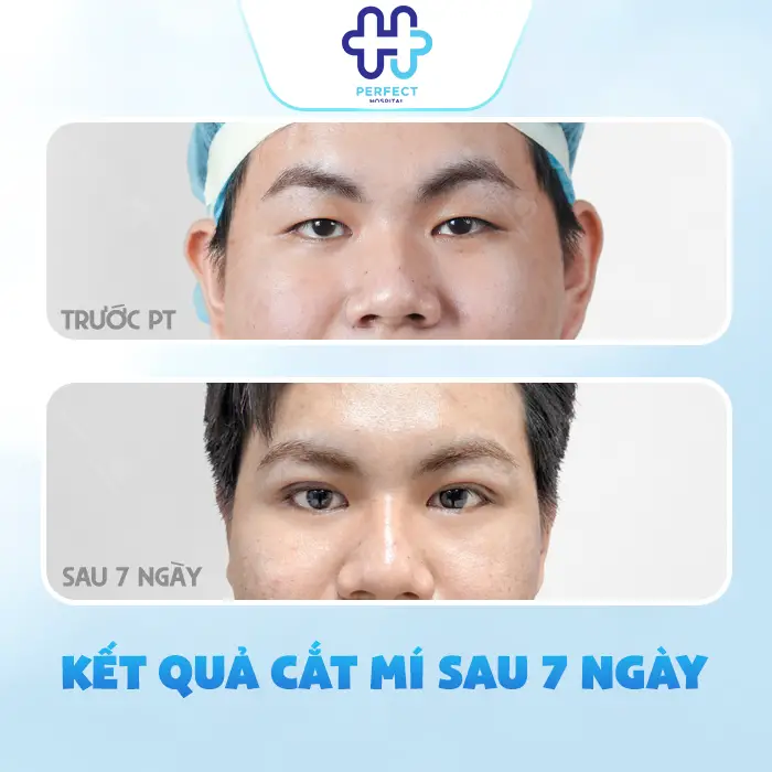 Nâng Mũi Bị Bầm Mắt Có Sao Không Và Cách Giảm Tím Nhanh