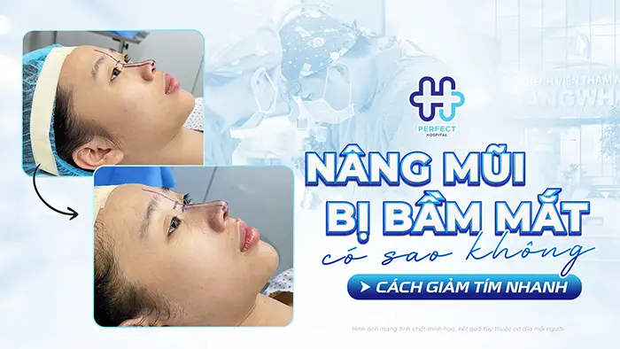 Nâng Mũi Bị Bầm Mắt Có Sao Không Và Cách Giảm Tím Nhanh