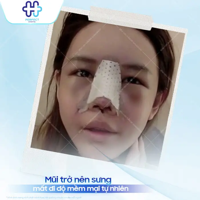 Nâng Mũi Bị Bao Xơ Là Gì? Dấu Hiệu Nhận Biết Và Cách Xử Lý