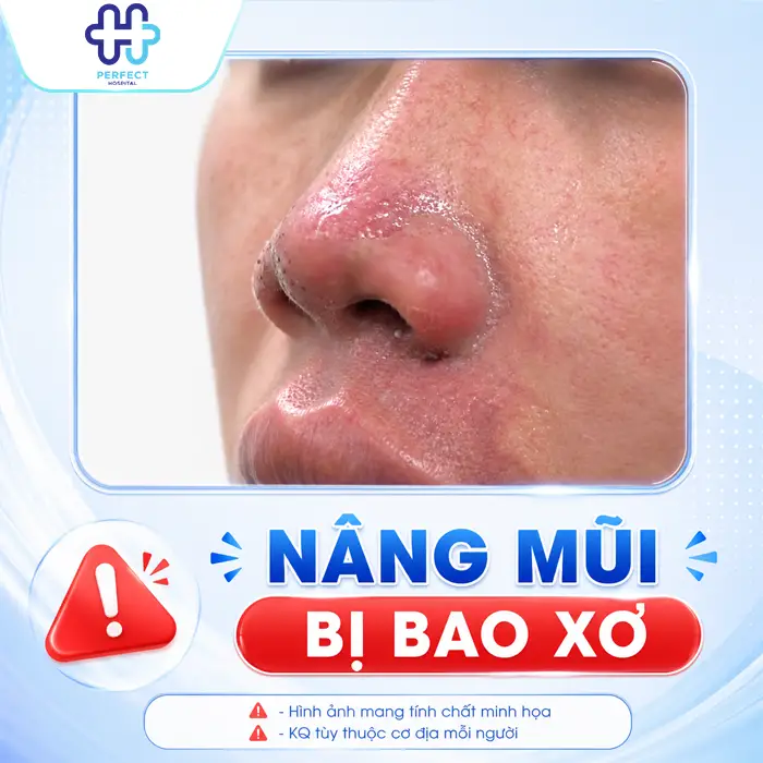 Nâng Mũi Bị Bao Xơ Là Gì? Dấu Hiệu Nhận Biết Và Cách Xử Lý