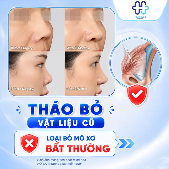 Nâng Mũi Bị Bao Xơ Là Gì? Dấu Hiệu Nhận Biết Và Cách Xử Lý