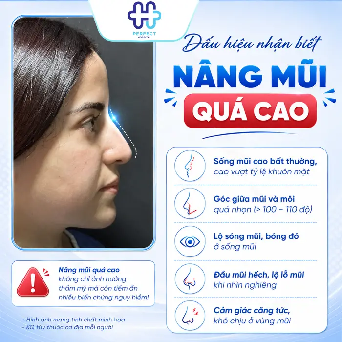 Nâng Mũi Bị Cao Quá Phải Làm Sao? Cách Khắc Phục An Toàn