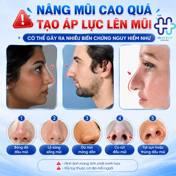 Nâng Mũi Bị Cao Quá Phải Làm Sao? Cách Khắc Phục An Toàn