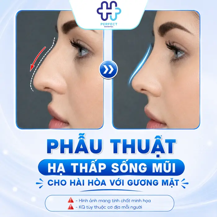 Nâng Mũi Bị Cao Quá Phải Làm Sao? Cách Khắc Phục An Toàn