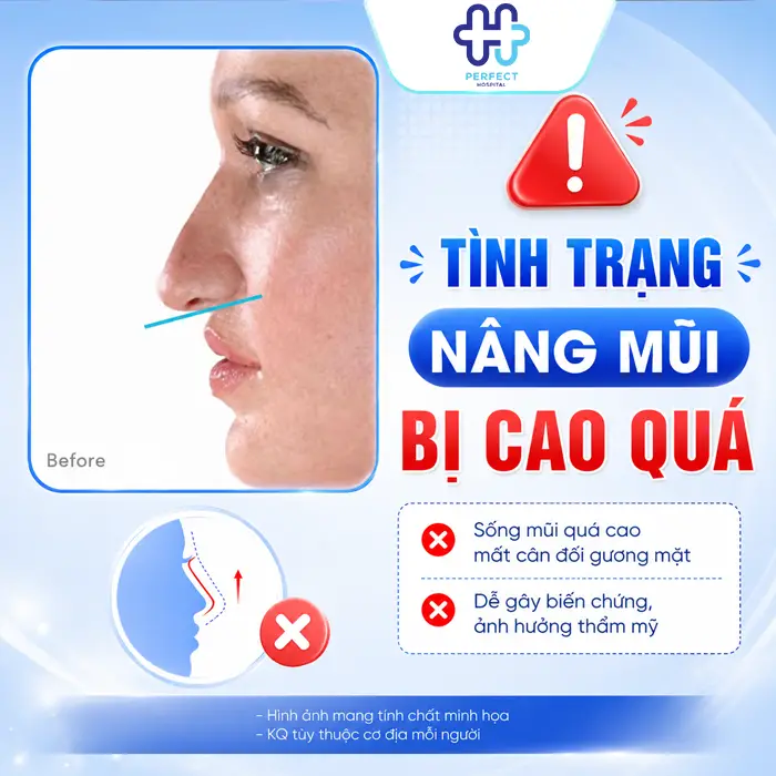 Nâng Mũi Bị Cao Quá Phải Làm Sao? Cách Khắc Phục An Toàn