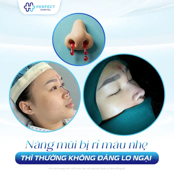 Nâng Mũi Bị Chảy Máu Có Nguy Hiểm Không Và Cách Xử Lý An Toàn