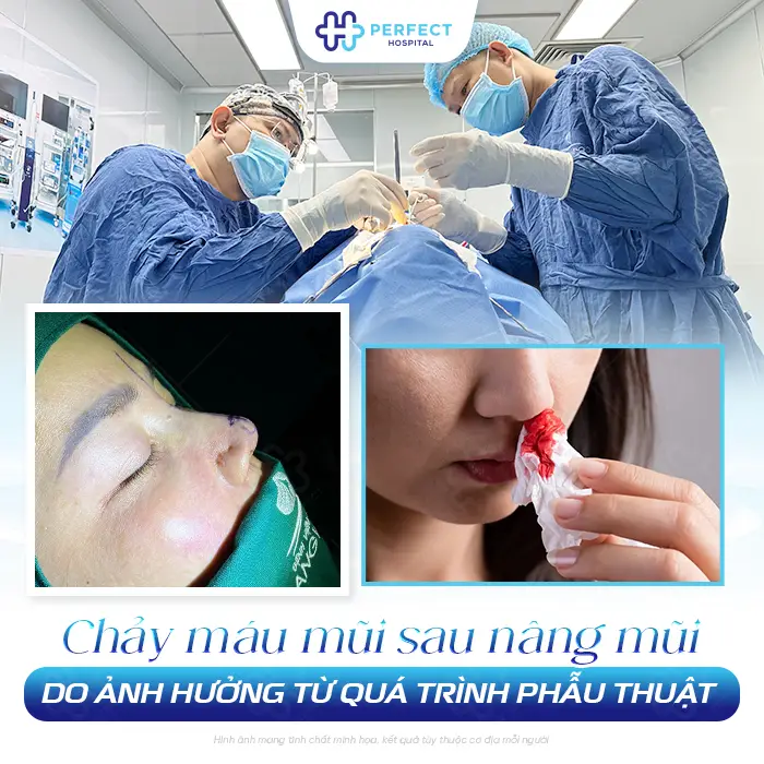 Nâng Mũi Bị Chảy Máu Có Nguy Hiểm Không Và Cách Xử Lý An Toàn