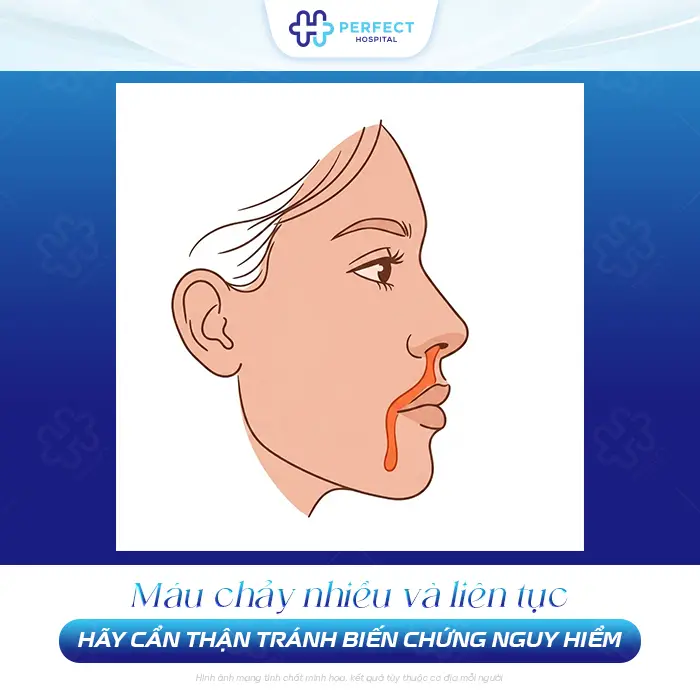 Nâng Mũi Bị Chảy Máu Có Nguy Hiểm Không Và Cách Xử Lý An Toàn