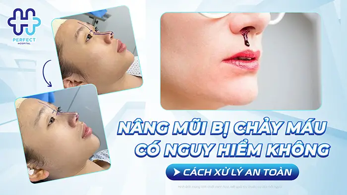 Nâng Mũi Bị Chảy Máu Có Nguy Hiểm Không Và Cách Xử Lý An Toàn