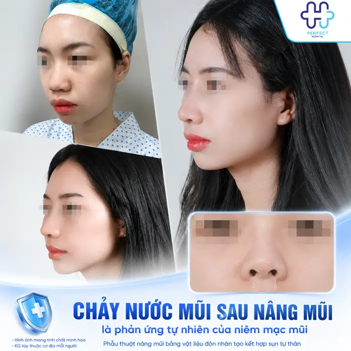Chảy Nước Mũi Sau Khi Nâng Mũi Có Nguy Hiểm Không Và Cách Xử Lý