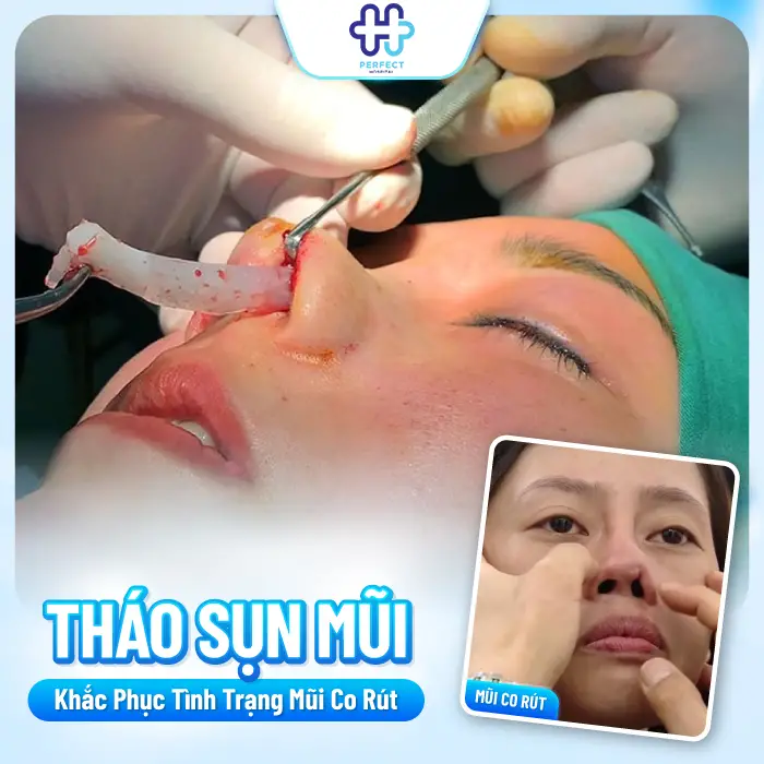 Nâng Mũi Bị Co Rút Có Nguy Hiểm Không? Nguyên Nhân Và Cách Khắc Phục