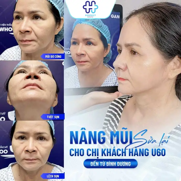 Nâng Mũi Bị Co Rút Có Nguy Hiểm Không? Nguyên Nhân Và Cách Khắc Phục