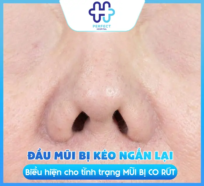 Nâng Mũi Bị Co Rút Có Nguy Hiểm Không? Nguyên Nhân Và Cách Khắc Phục