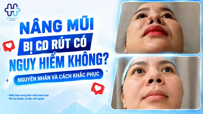 Nâng Mũi Bị Co Rút Có Nguy Hiểm Không? Nguyên Nhân Và Cách Khắc Phục