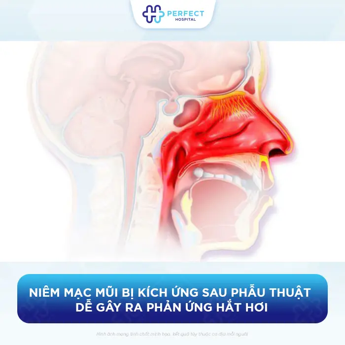 Nâng Mũi Bị Hắt Hơi Có Sao Không Và Có Được Xì Mũi Không