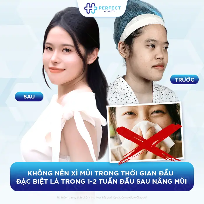 Nâng Mũi Bị Hắt Hơi Có Sao Không Và Có Được Xì Mũi Không