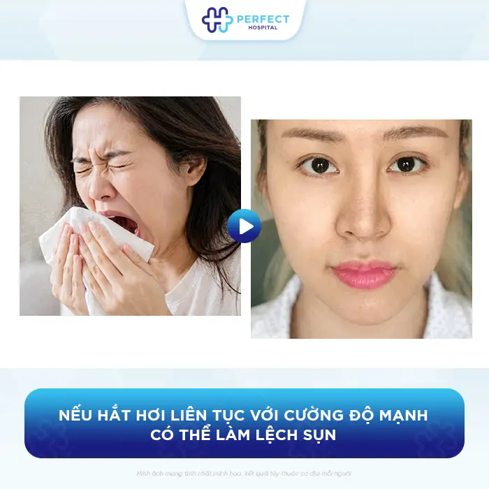 Nâng Mũi Bị Hắt Hơi Có Sao Không Và Có Được Xì Mũi Không