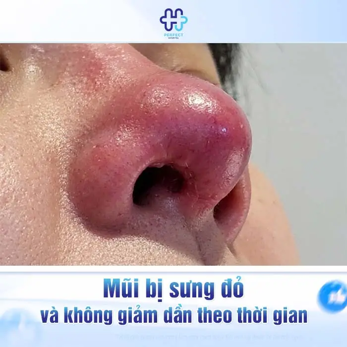Nâng Mũi Bị Hở Vết Thương Có Nguy Hiểm Không Và Cách Xử Lý An Toàn