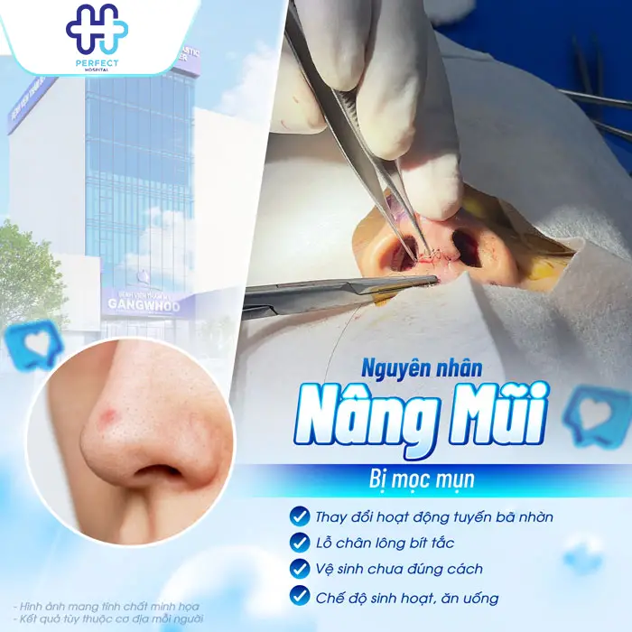 Nâng Mũi Bị Mọc Mụn Có Sao Không Và Cách Xử Lý An Toàn