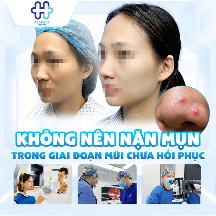 Nâng Mũi Bị Mọc Mụn Có Sao Không Và Cách Xử Lý An Toàn