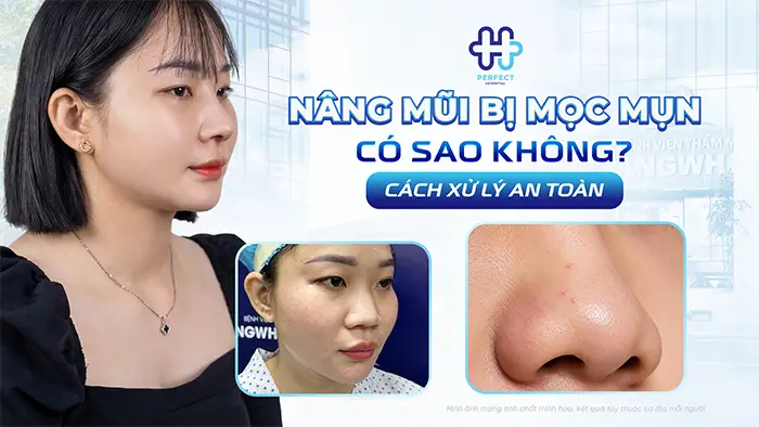 Nâng Mũi Bị Mọc Mụn Có Sao Không Và Cách Xử Lý An Toàn