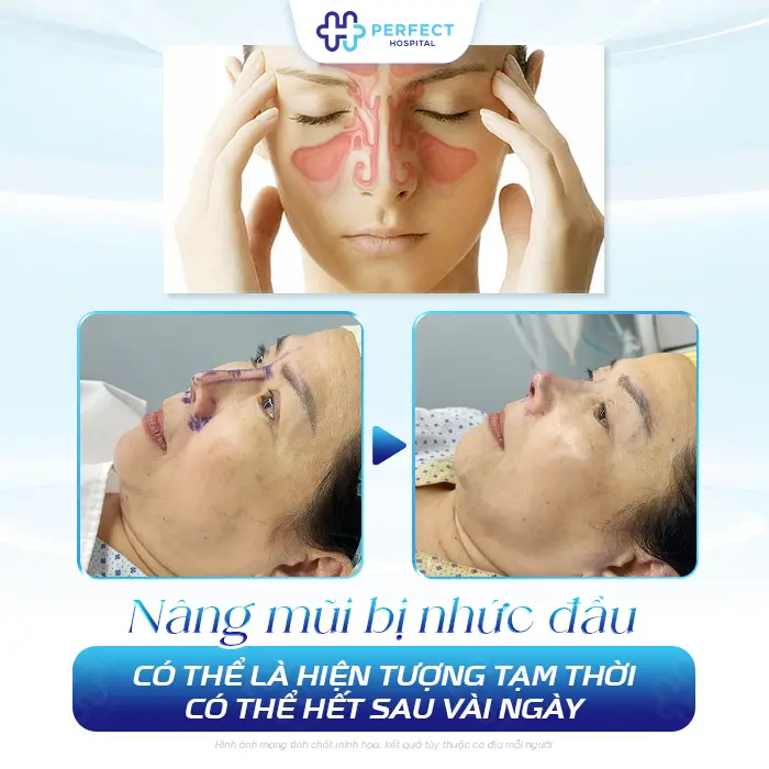 Nâng Mũi Bị Nhức Đầu Có Sao Không? Nguyên Nhân Và Cách Xử Lý
