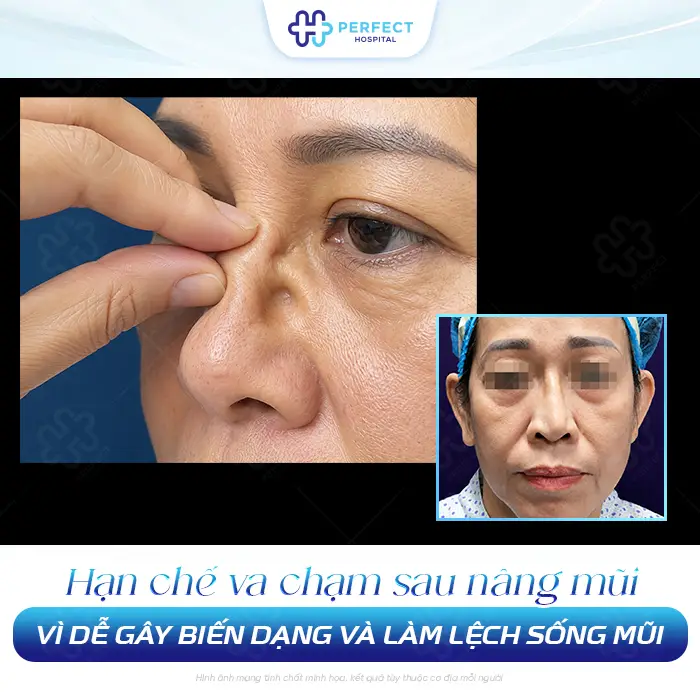 Nâng Mũi Bị Va Chạm Có Sao Không? Cách Xử Lý An Toàn